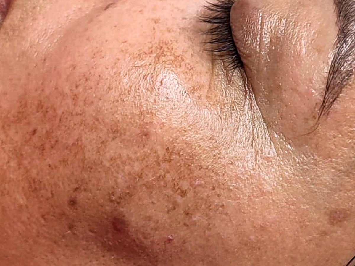 Antes: Cosmelan para melasma