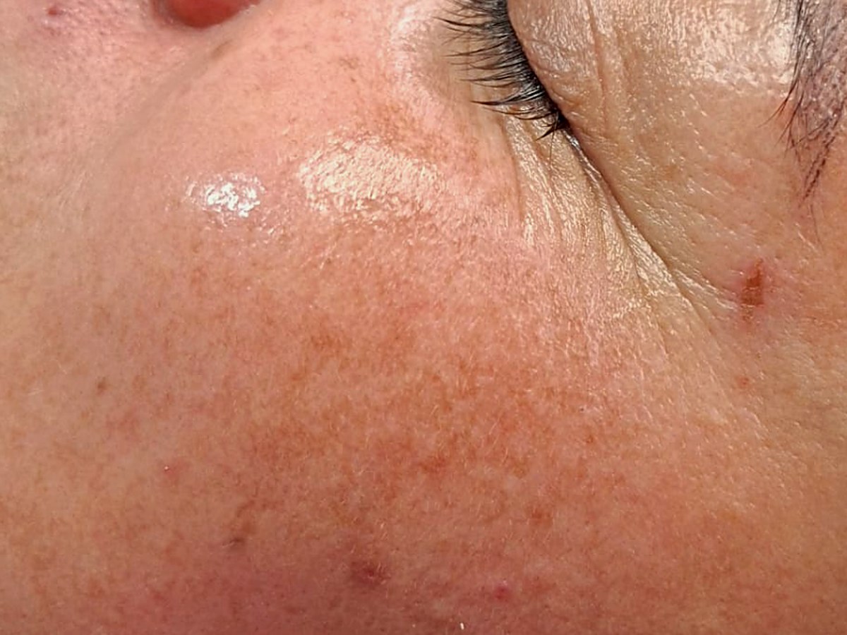 Después: Cosmelan para melasma
