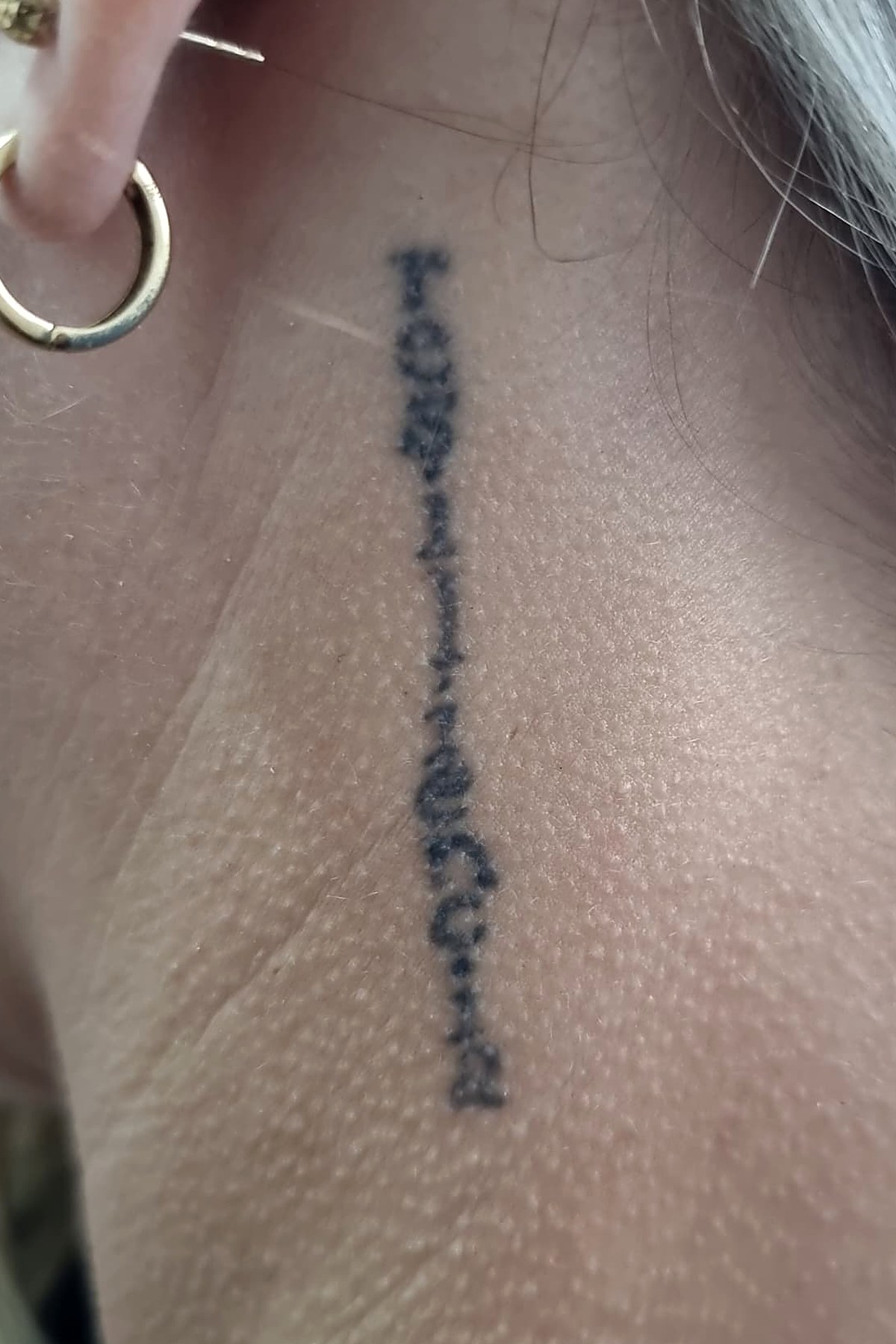 Antes: Eliminación de tatuajes