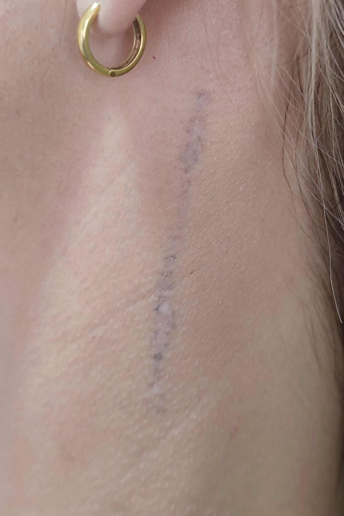Después: Eliminación de tatuajes