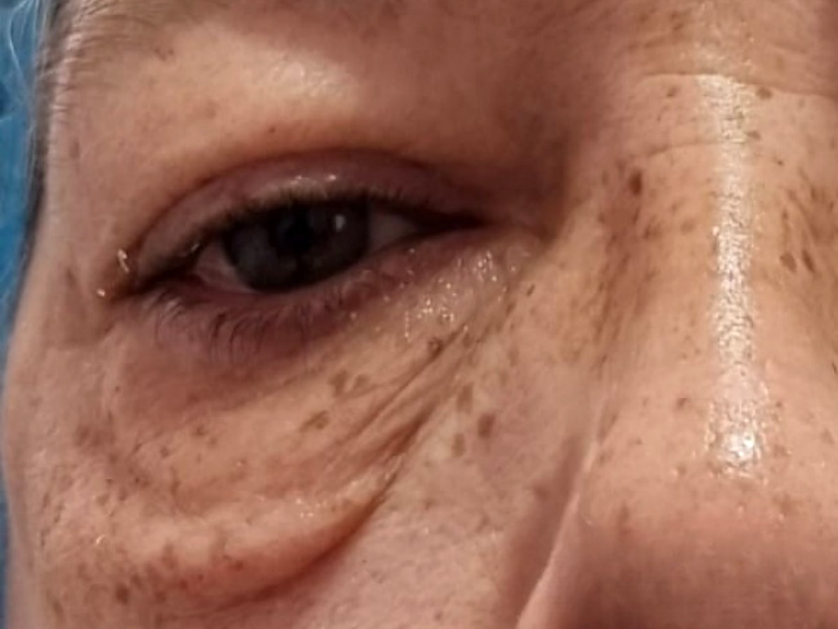 Antes: Fibroblast