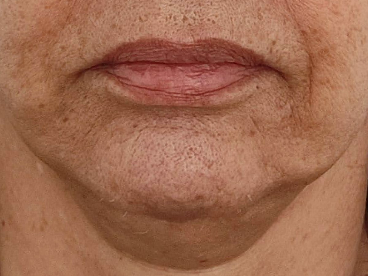 Antes: HIFU facial