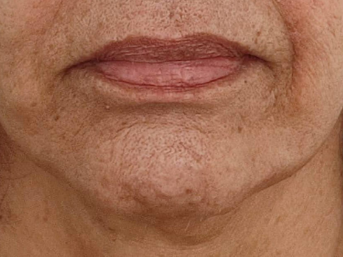 Después: HIFU facial