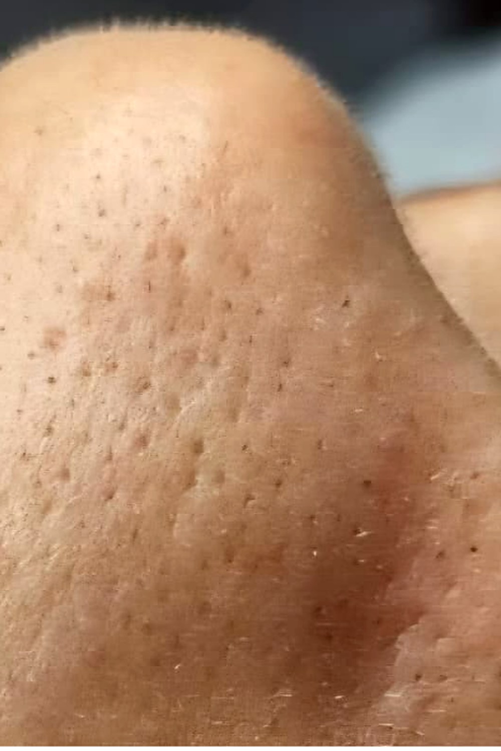 Antes: Hydrafacial
