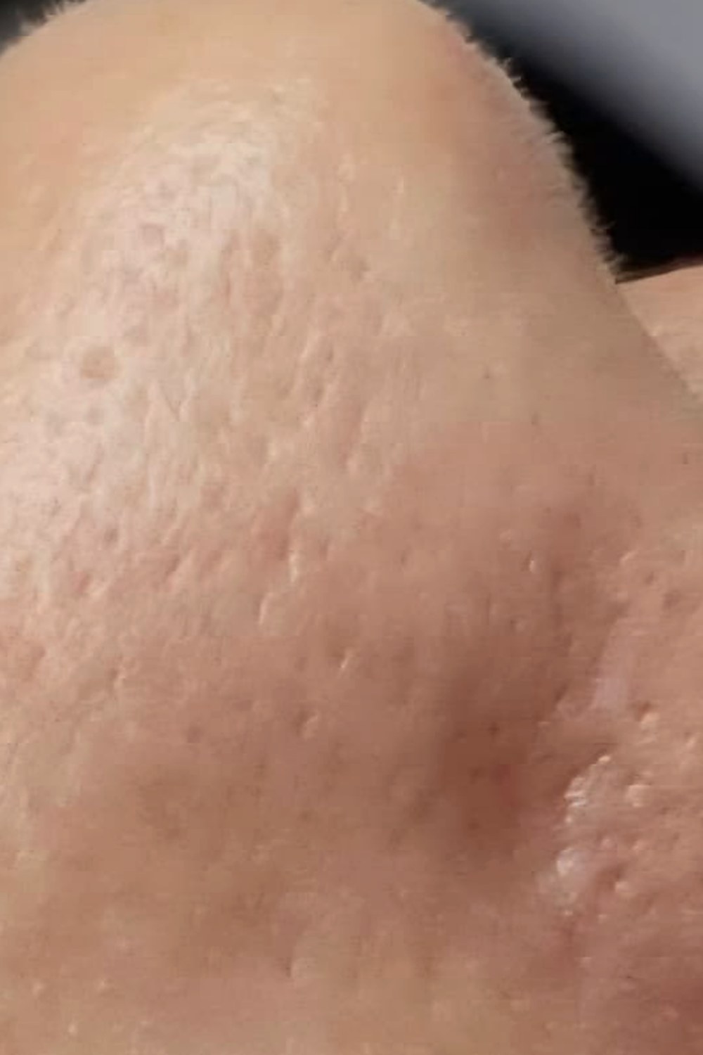 Después: Hydrafacial