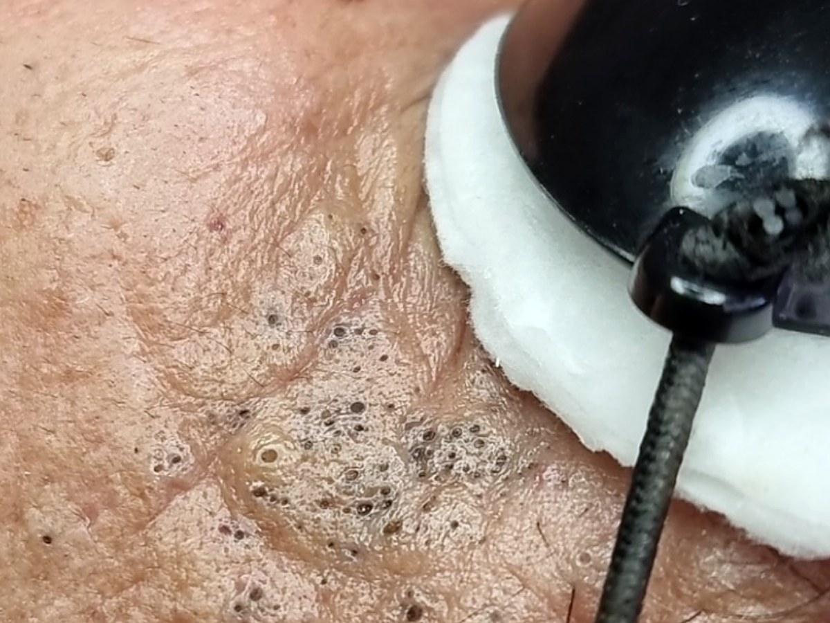 Antes: Limpieza facial profunda