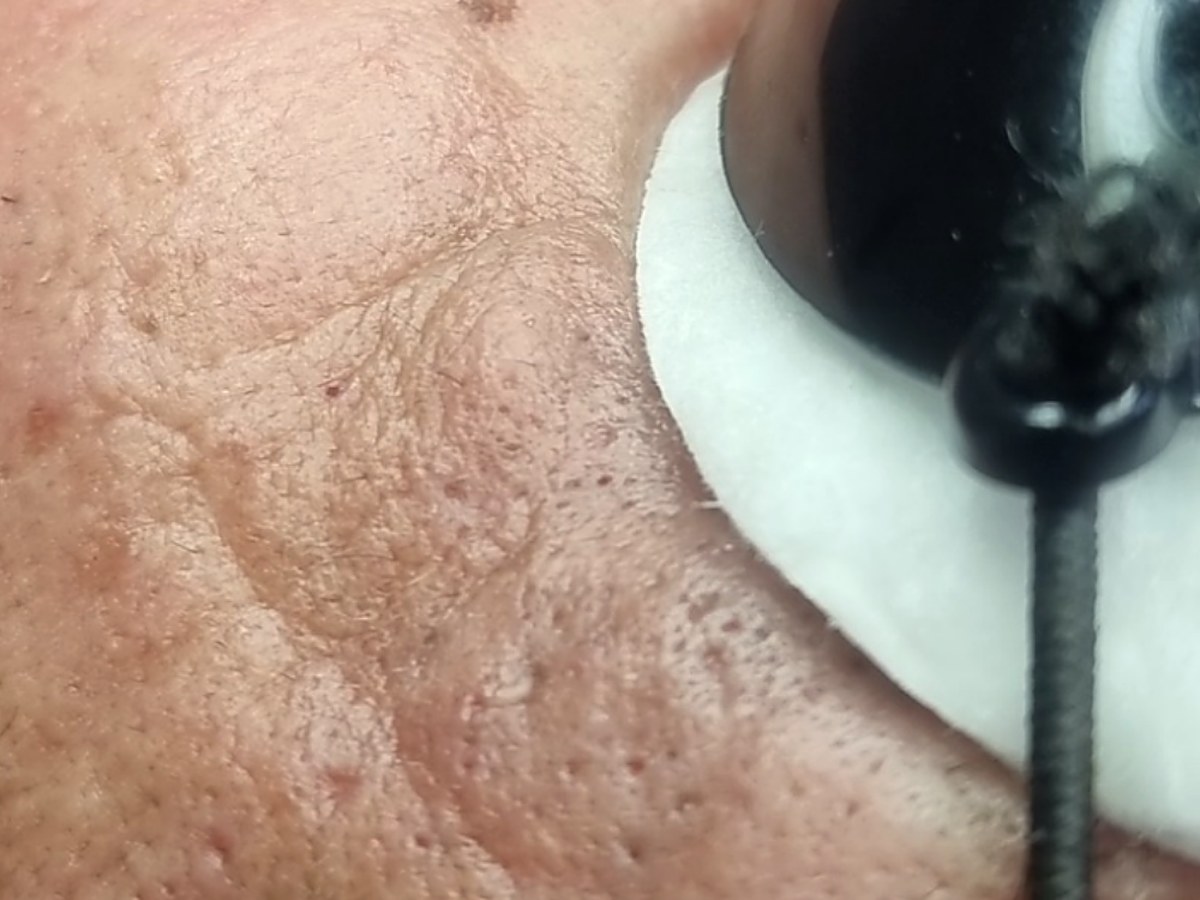 Después: Limpieza facial profunda