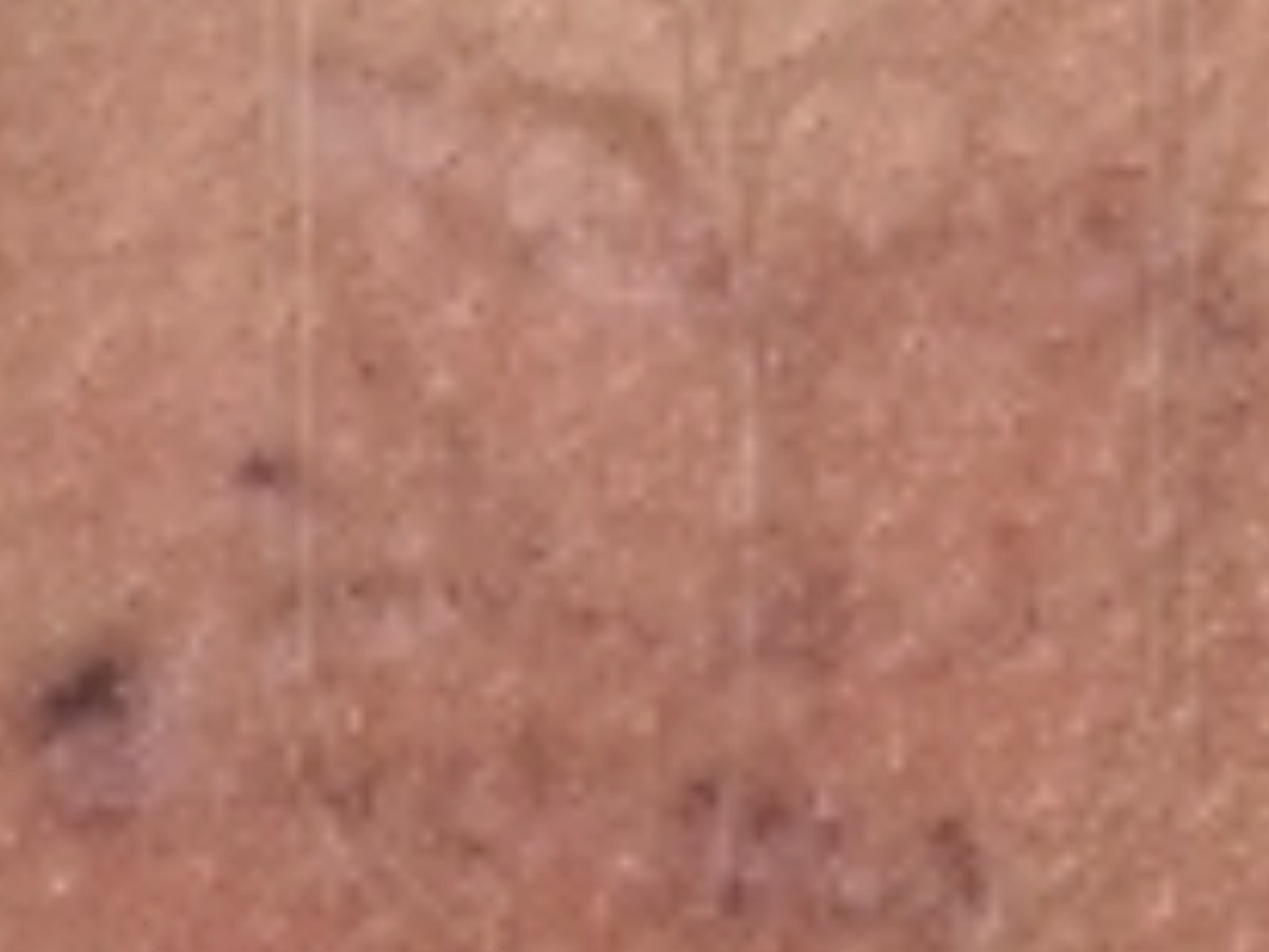 Después: Eliminación de tatuajes · 2 sesiones